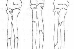 《骨科学》第五节　尺桡骨干骨折