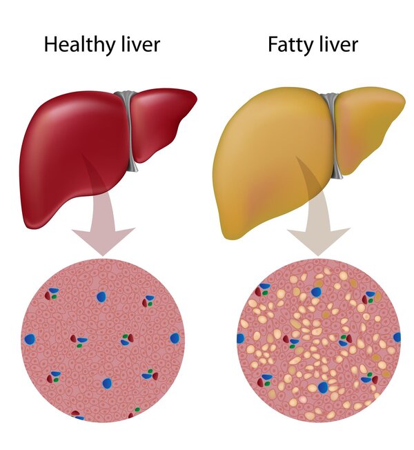 远离脂肪肝 中医传授脂肪肝健康食谱