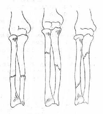 《骨科学》第五节　尺桡骨干骨折