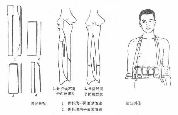 分肌垫放置法