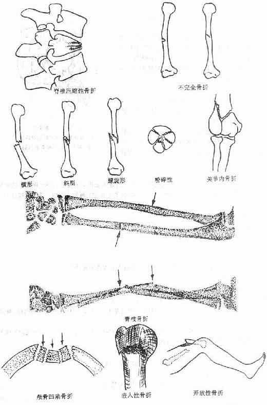 《骨科学》第一节　骨折的定义、成因、分类与骨折段的移位