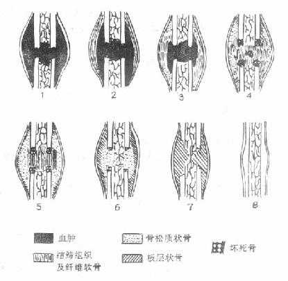 骨折愈合的过程