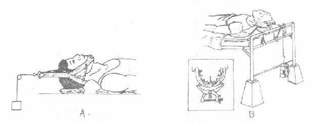 颈椎骨折脱位牵引复位