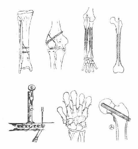 骨折内固定
