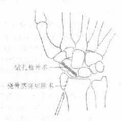 陈旧性舟骨骨折的手术治疗