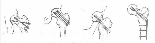 股骨颈骨折内固定方式