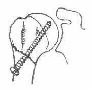 《骨科学》第二节　肱骨外科颈骨折