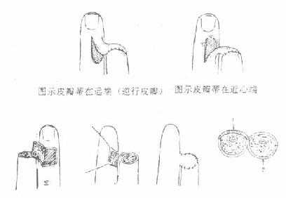 《骨科学》第二节　开放性手部损伤的处理