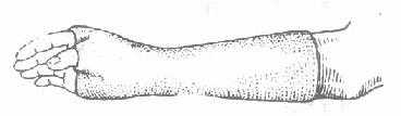 腕舟骨骨折的石膏固定