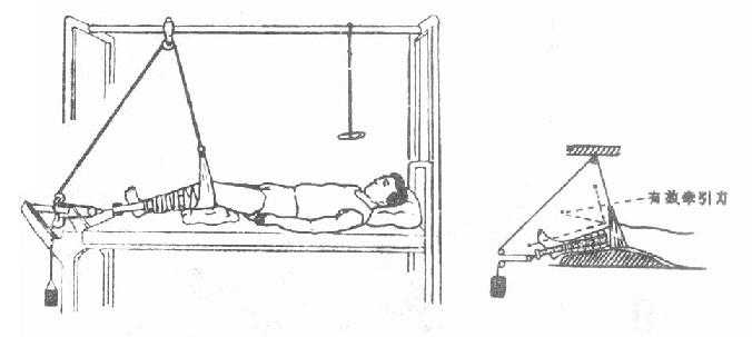 动滑车皮肤牵引法（Russell氏法）