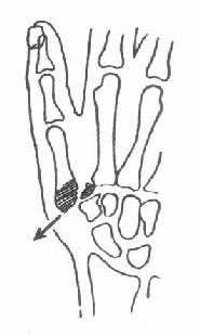 《骨科学》第三节　手部骨关节损伤