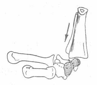《骨科学》第三节　手部骨关节损伤