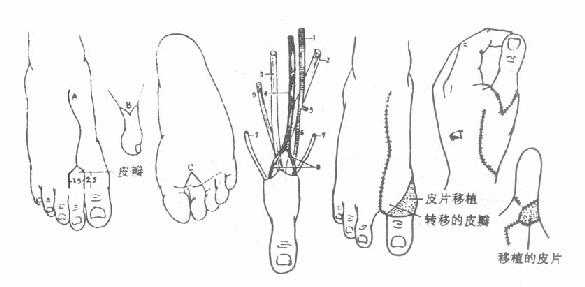 《骨科学》第六节　拇指再造术