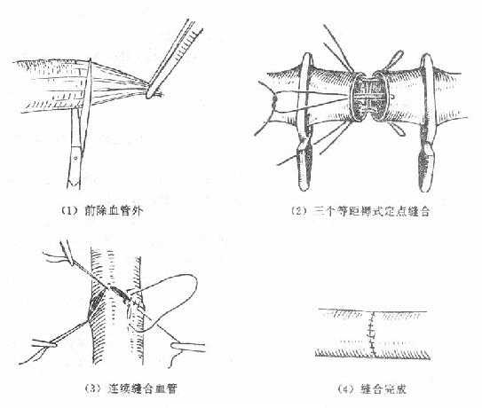 血管对端吻合术