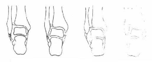 《骨科学》第一节　踝关节扭伤
