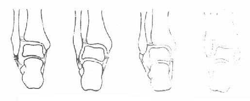 踝部韧带断裂与撕脱骨折