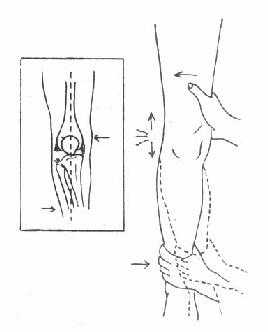 《骨科学》第三节　膝关节常见损伤