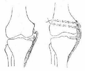 《骨科学》第三节　膝关节常见损伤