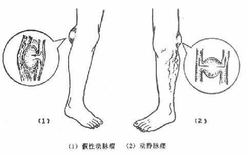 假性动脉瘤与动静脉瘘