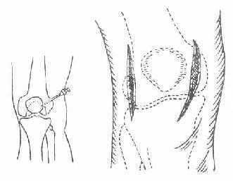 膝关节穿刺及切开引流