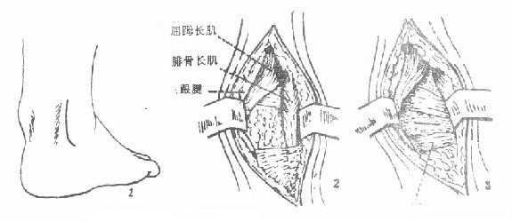 踝关节后外侧切开引流