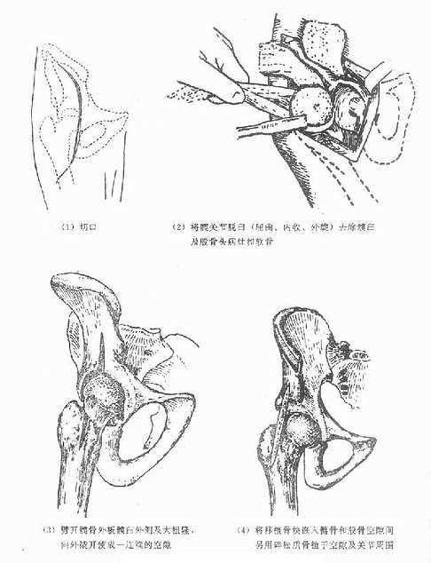 髋关节结核病灶清除与关节融合术