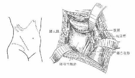 骶髂关节结核病灶清除术，前显露法