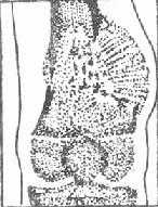 《骨科学》第五节 骨肉瘤 《骨科学》第五节 骨肉瘤