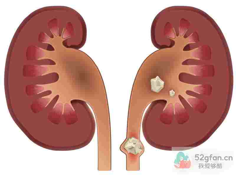 呼吸疾病 肾结石不治，或需要承担这些“恶果”！__肾病