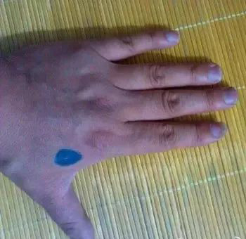 26个民间中医治病小妙招