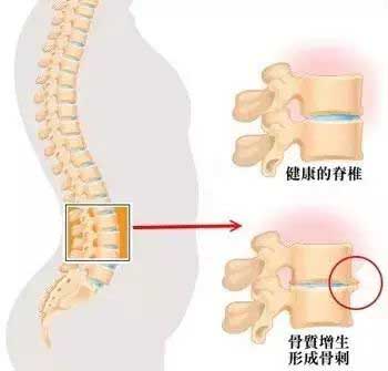 醋调急乌散外包治疗骨质增生