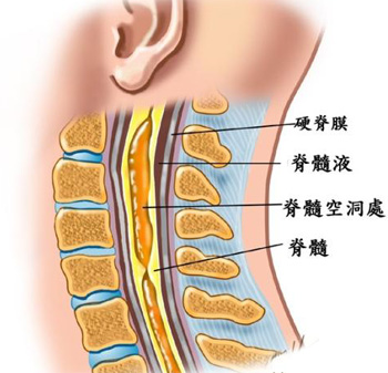 治愈脊髓空洞导致的瘫痪