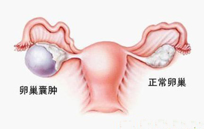 卵巢囊肿验案一则