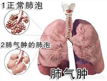 肺气肿