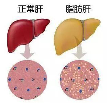 脂肪肝
