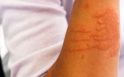 荨麻疹-民间偏方