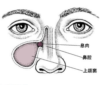 白矾、硇砂、冰片治好我的鼻息肉