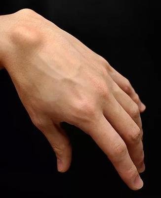皮下脂肪瘤十天消散方