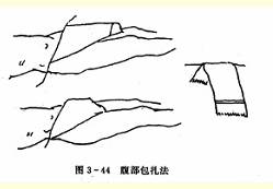  腹部毛巾包扎法